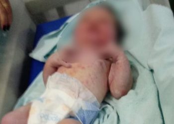 Bebê é encontrado com corpo coberto de marcas de picadas de formigas