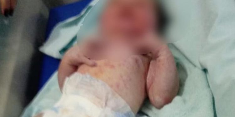 Bebê é encontrado com corpo coberto de marcas de picadas de formigas