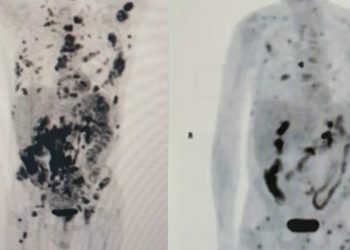 Imagem mostra regressão de câncer em paciente após tratamento inédito