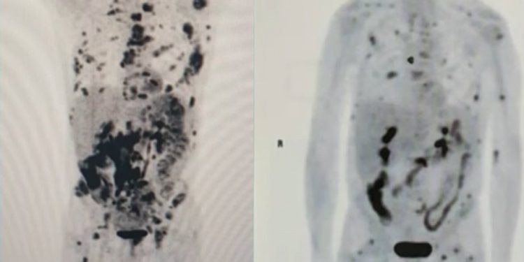 Imagem mostra regressão de câncer em paciente após tratamento inédito