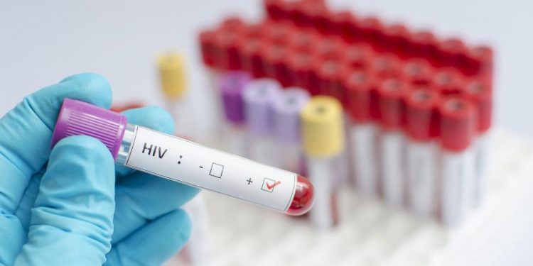 135 mil pessoas convivem com HIV no país e não sabem
