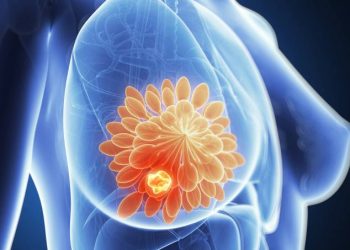 Novo tratamento para câncer de mama adia quimioterapia por até 4 anos