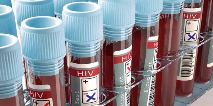 Em 11 anos, taxa de detecção de Aids no Ceará cresce 9,8%