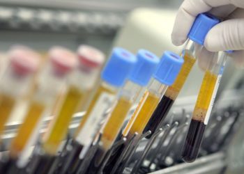 Crato contabiliza 4 casos suspeitos de coronavírus; no Ceará 51 casos são descartados