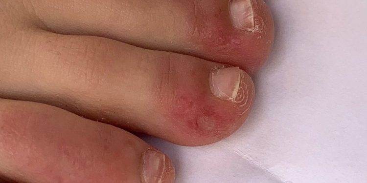 Coronavírus: o que são os ‘dedos de covid’, um dos mais novos possíveis sintomas identificados da doença?