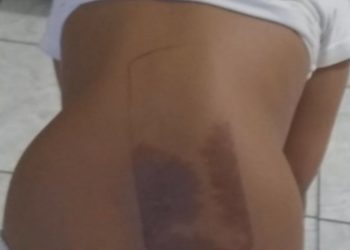 Criança teve as costas queimadas por celular (Foto: Reprodução)