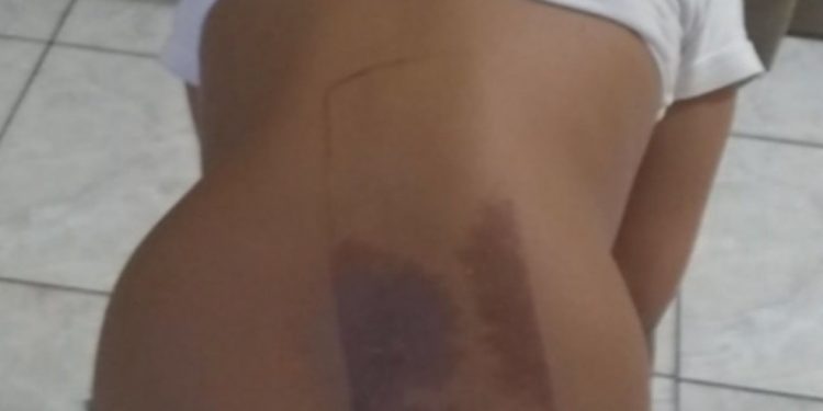 Criança de 7 anos sofre queimaduras nas costas após dormir em cima do celular