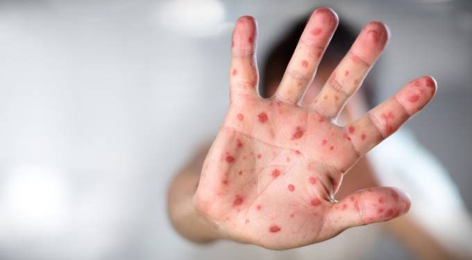 Altamente contagioso, sarampo matou mais de 200 mil em 2019, alerta OMS
