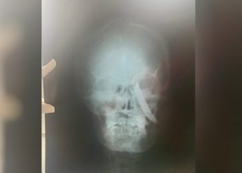 Mulher sofre facada na cabeça em tentativa de feminicídio em Morada Nova, no interior do Ceará; suspeito é preso (Foto: Arquivo pessoal)