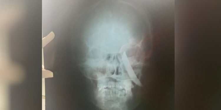 Mulher tem faca cravada no crânio em tentativa de feminicídio, em Morada Nova