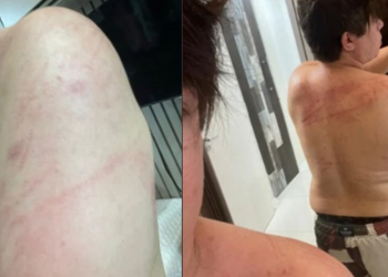 DJ Ivis aparece ferido em fotos e Pamella Holanda diz: “Nunca o vi assim”