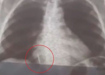 Paciente extrai dente e sai de consultório com broca no pulmão no interior do RN (Foto: Reprodução)