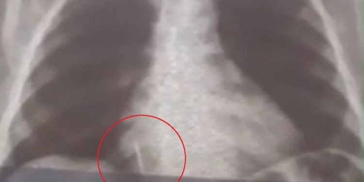 Broca de dentista se solta durante atendimento e vai parar dentro de pulmão de paciente