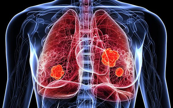 Câncer de pulmão: causas, sintomas, diagnóstico e tratamento