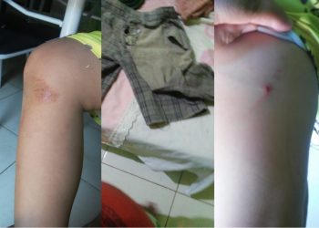 Além dos ferimentos, a roupa da criança também ficou danificada após o ataque do animal, em Várzea Alegre (Foto: Arquivo pessoal)