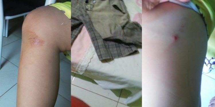 Menino de 7 anos fica ferido após ataque de pitbull em Várzea Alegre