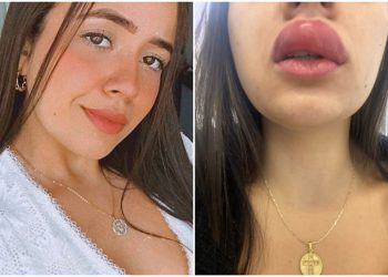 Jovem disse que boca e garganta incharam e precisou tomar medicação (Foto: Arquivo pessoal)