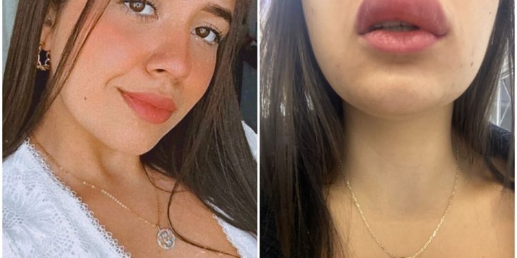 Jovem fica com lábio gigante após ser picada por lacraia enquanto dormia