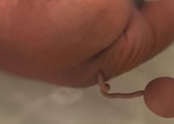 Mensagem que relaciona vacina contra Covid-19 a nascimento de criança com cauda no CE