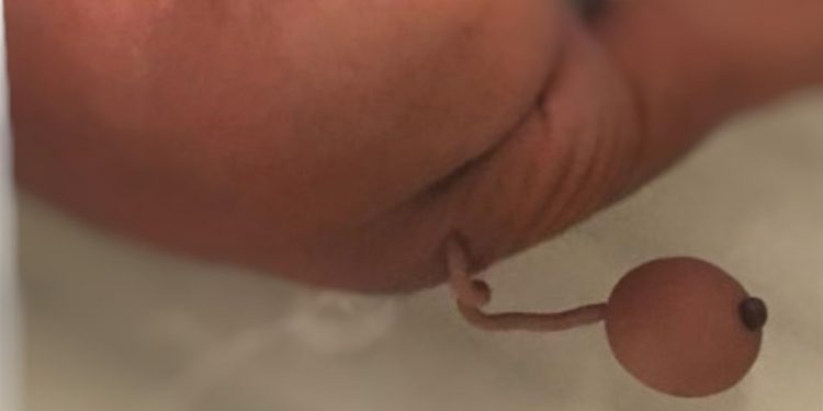 Mensagem que relaciona vacina contra Covid-19 a nascimento de criança com cauda no CE