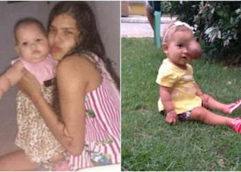 À esquerda Maria Hena e a mãe Marcela antes do crescimento do tumor. À direita Maria Helena com o tumor já avançado (Foto: Arquivo pessoal)