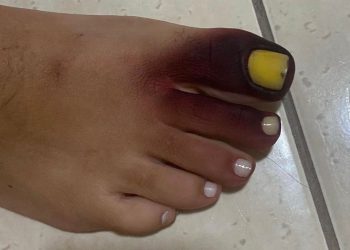 Contato com gongolo fez com que dedo do pé de Thassynara Vargas (Foto: Reprodução/Instagram)