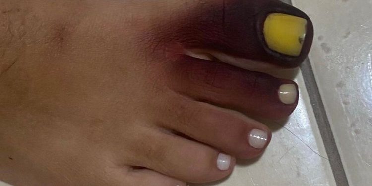 Mulher fica com pé roxo e unha amarela ao calçar tênis com piolho-de-cobra
