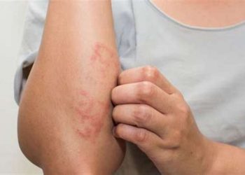 Surto de sarna humana tem sido registrado na Região Metropolitana do Recife e tem um caso no litoral de São Paulo (Foto: Bigstock)