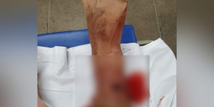 Guarda municipal se nega a usar máscara em hospital, agride funcionária, leva tiro na perna e é preso no Ceará