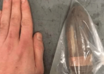 Projétil da Segunda Guerra Mundial foi retirado do reto de um paciente (Foto: Reprodução)