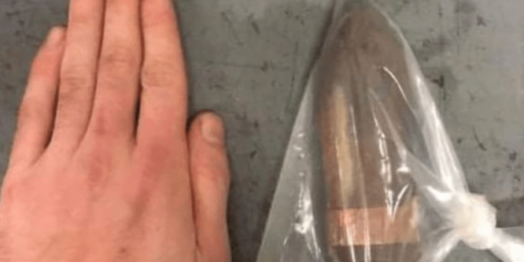 Homem com projétil de canhão no reto faz hospital acionar equipe antibomba