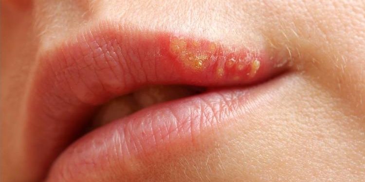 Ardência e coceira são os principais sinais de alerta que antecedem o aparecimento de herpes