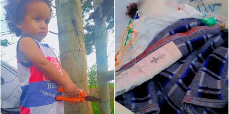 Bebê é internado em UTI com 80% do corpo queimado após panela com água quente cair sobre ele