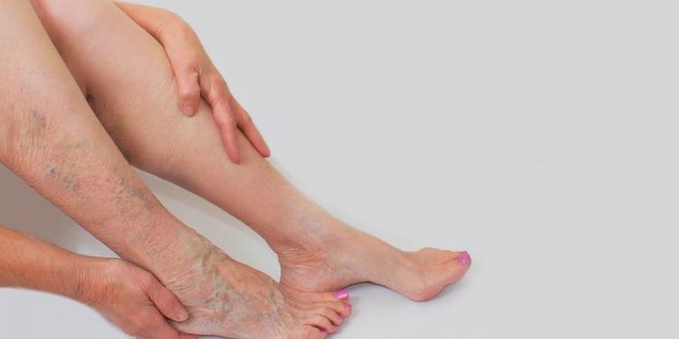 Coronavírus e varizes: o que sabemos sobre efeitos da Covid na circulação