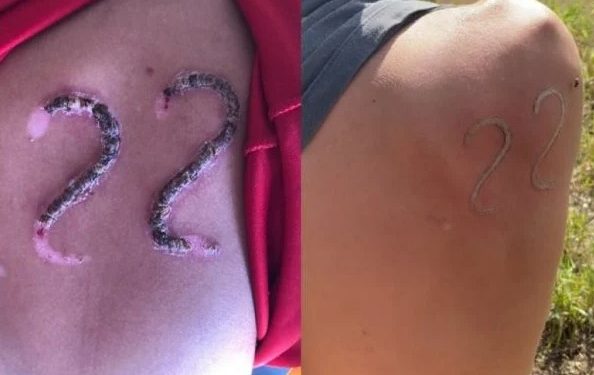 Com ferro em brasa, jovem marca 22 de Bolsonaro na pele