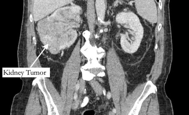Homem vai tratar dor no dedão do pé e descobre tumor em fase terminal