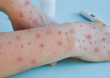 Secretaria da Saúde do Ceará confirma o quarto caso de varíola do macaco no Estado (Foto: Shutterstock)