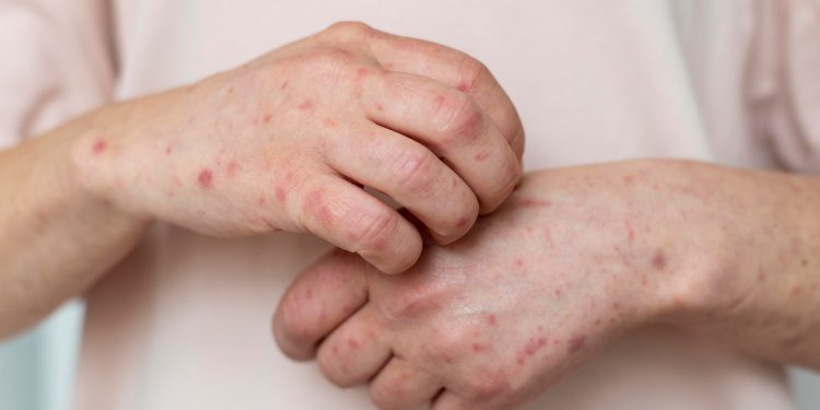 Ceará já tem 48 cidades com casos suspeitos de monkeypox