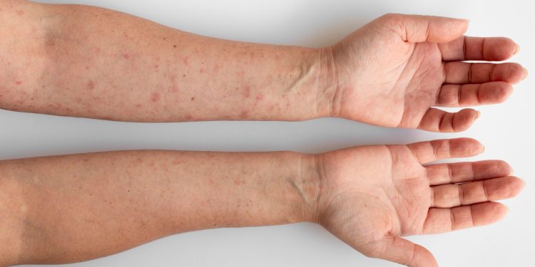 Barbalha tem um caso confirmado de varíola dos macacos