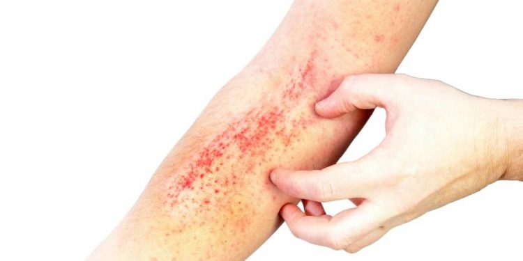 Manchas vermelhas na pele: conheça 11 causas comuns e quando é grave