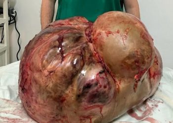 Tumor com cerca de 46 kg é retirado de paciente em Itaperuna, no RJ (Foto: Divulgação/Glacio Boecheat)