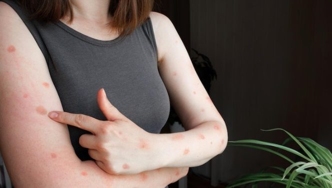 59 cidades do Ceará já têm casos suspeitos ou prováveis de monkeypox