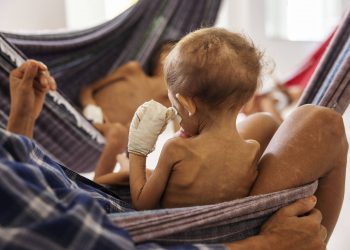 Criança yanomami internada com desnutrição grave em hospital de Boa Vista (Foto: Lalo de Almeida/Folhapress)