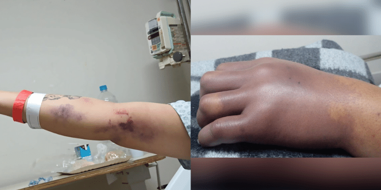 Mulher vai para hospital dar à luz e volta com mão e punho amputados