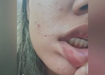 Jovem de 22 anos ficou com ferimentos no rosto e na boca após agressão ocorrida em junho de 2021 (Foto: Arquivo pessoal)