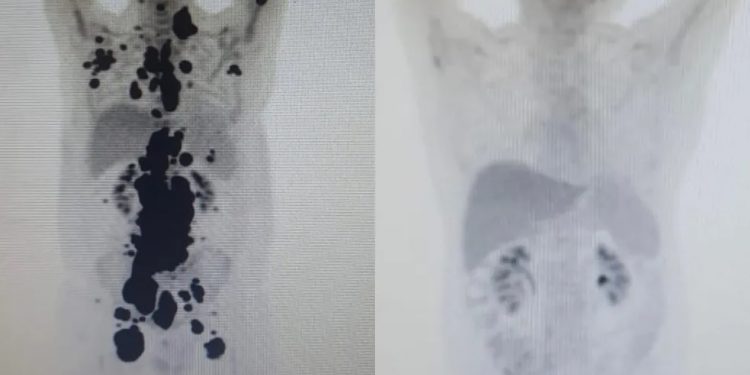 Paciente com câncer há 13 anos tem remissão completa em um mês após terapia celular em estudo na rede pública