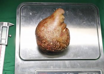 Médicos retiram de paciente a maior e mais pesada pedra no rim do mundo (Foto: Exército do Sri Lanka)