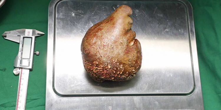 Médicos retiram de paciente a maior e mais pesada pedra no rim do mundo