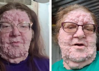 Mulher com doença rara choca internet: “Não posso mais me esconder”