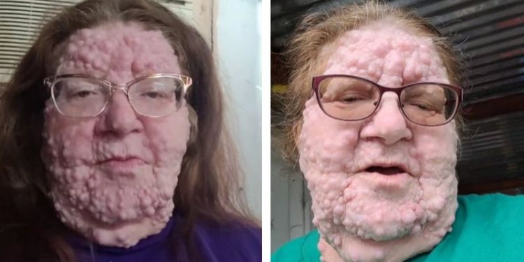 Mulher com doença rara choca internet: “Não posso mais me esconder”